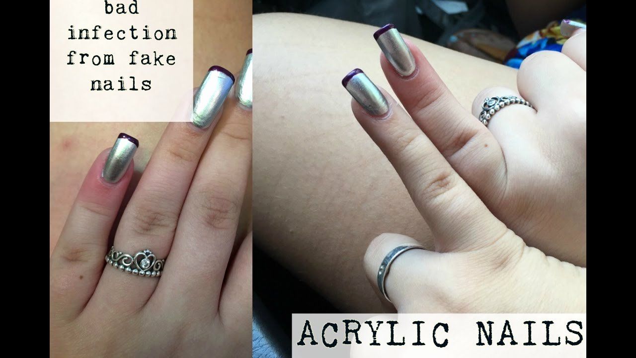 When We Think About Nail Infections Fungus Is Probably What First Comes To Mind However We Also Need To Be Nail Fungus Treatment Nail Problems Nail Infection