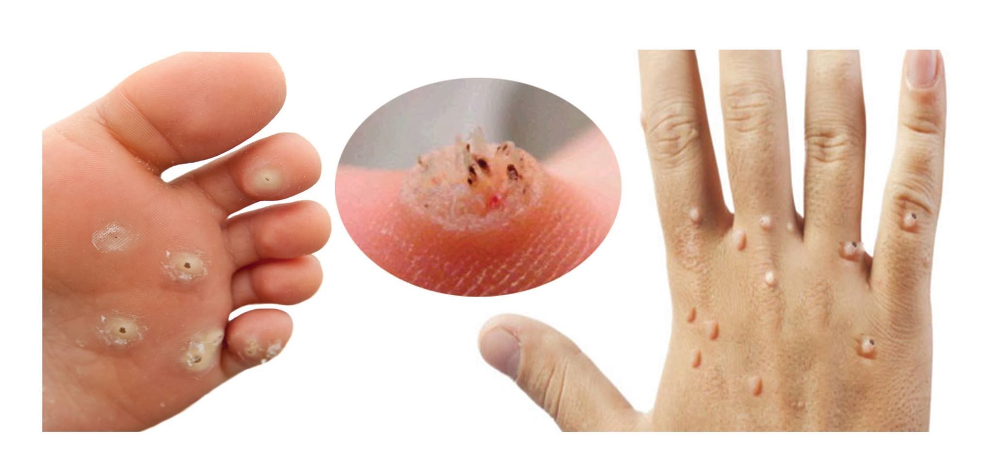 How to treat papilloma virus How to treat papilloma virus