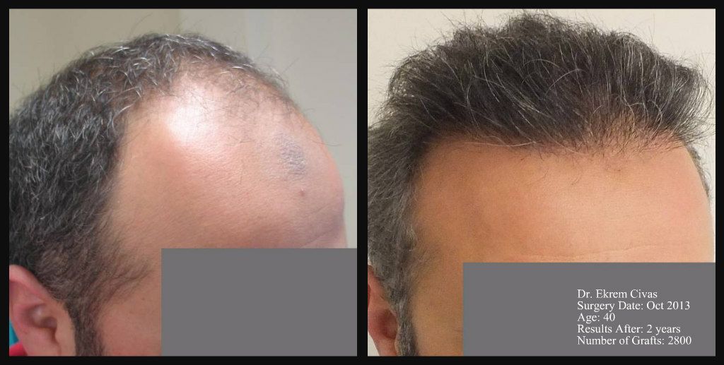 pin by civas hair transplant clinic turkey on civas hair transplant hair transplant turkey photos pictures photographs