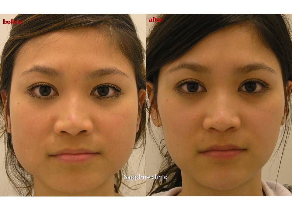 Anti estrogen for fat loss picture 8