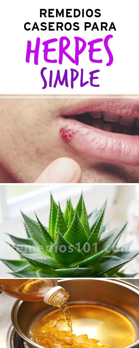 remedios caseros para curar la herpes simple