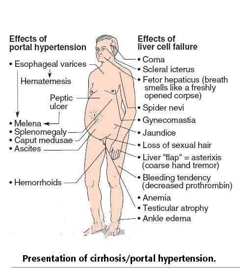 Caput medusae anatomía humana