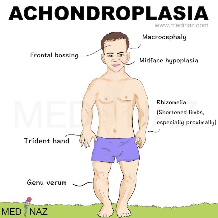 Achondroplasia – Artofit