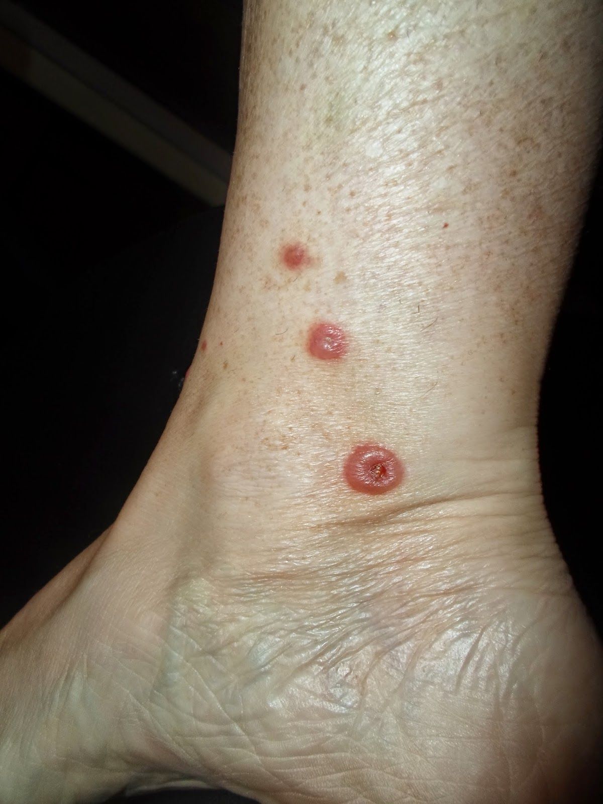 Chigger Bites Caused By Tiny Red Mites Chigger Bites Caused By Tiny Red Mites