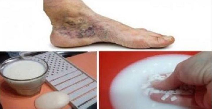 acid acetilsalicilic în varicoza