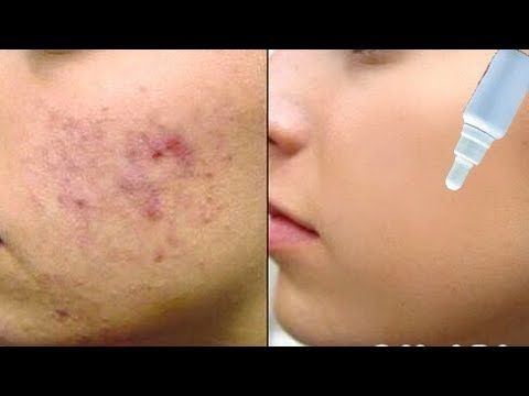 pimple-like vaginal sores Stuned fuck techer