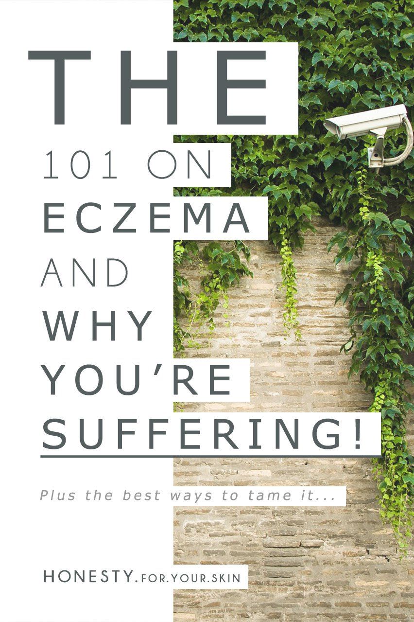 Eczema can be a pesky on-going skin condition that might make you want to hide under a rock and channel the scratching abilities of a cat. You are still absolutely looking beautiful my friend, so let me take your hand 'n pull you out from under that rock while we get down to the business of what's actually happening when your skin is suffering from eczema...? Why is it happening, why is it happening to you? And just what the heck can you do to avoid eczema flair-ups? http://wp.me/p6LuQS-Pg Foot Fungus Treatment, Snoring Remedies, Eczema Remedies, Natural Remedies, Natural Treatments, Skin Cream Anti Aging, Aging Skin, Top, Thighs