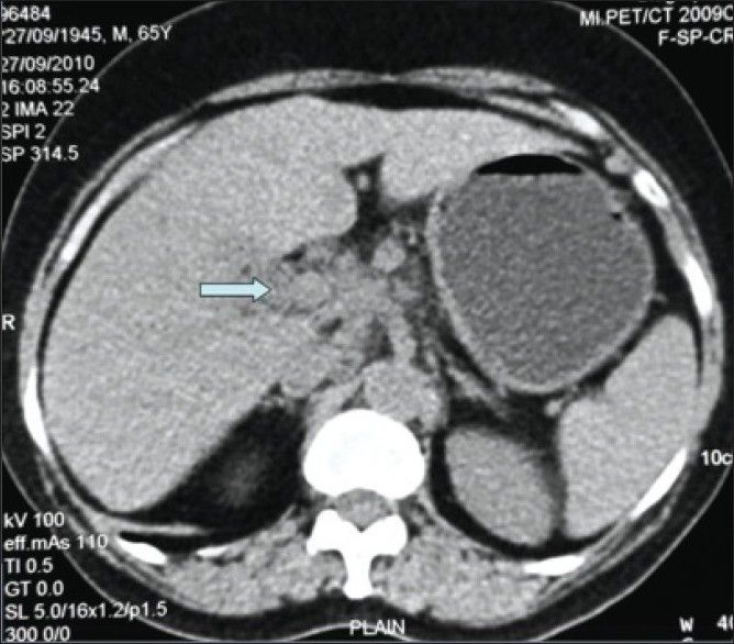 Synchronous primary gall bladder carcinoma and renal transitional cell