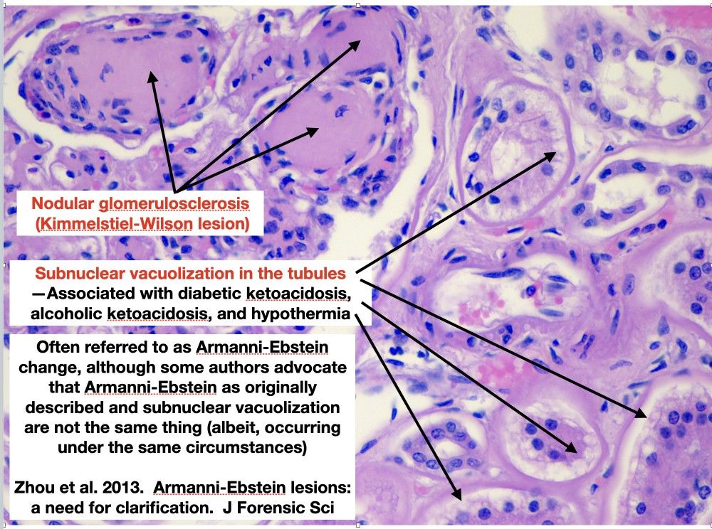 Diabetic Nephropathy Diabetic Nephropathy