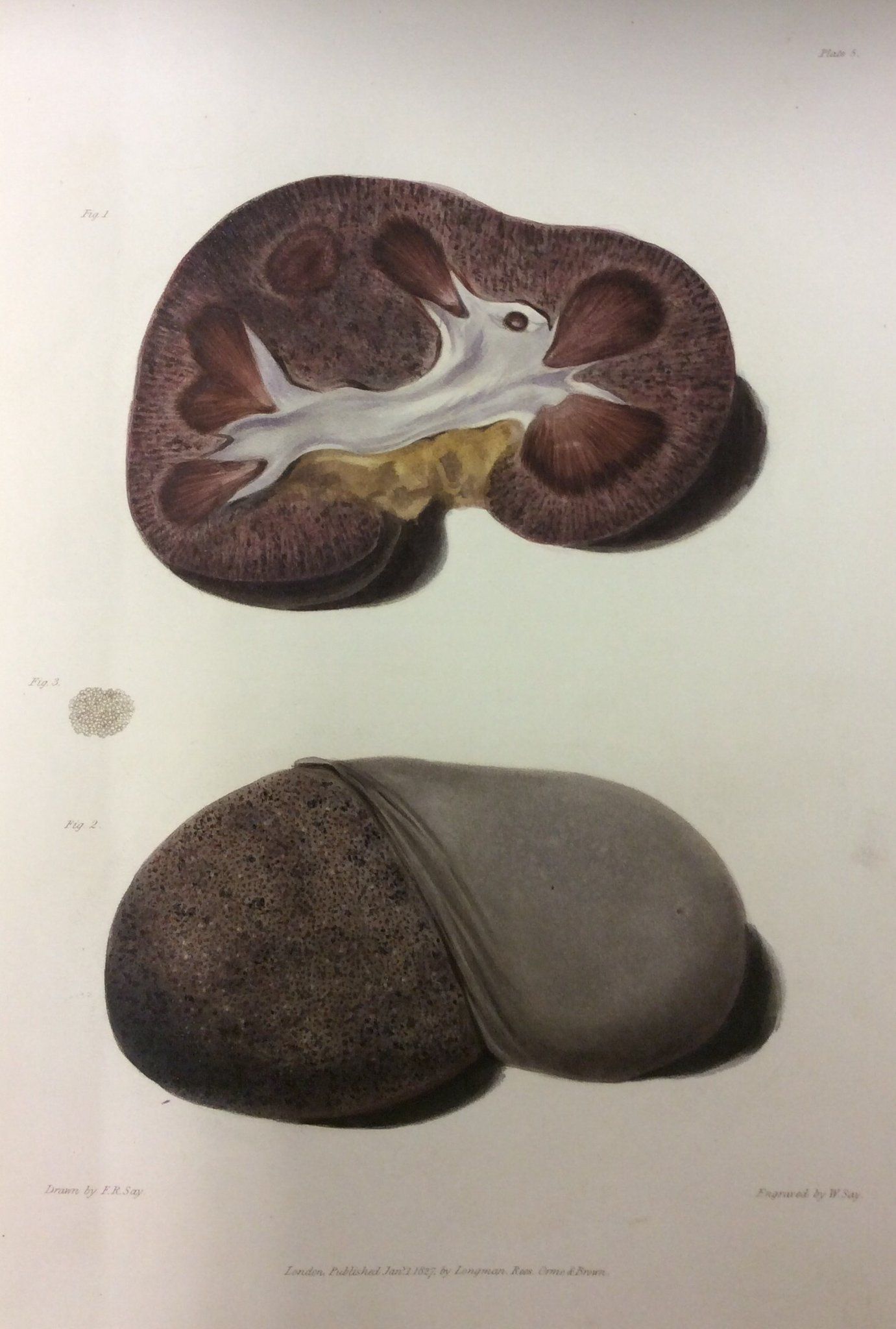 Image from Bright's Medical cases, 1827. Richard Bright first described Glomerulonephritis ( Bright's Disease). | Medical history, Medical, Richard bright