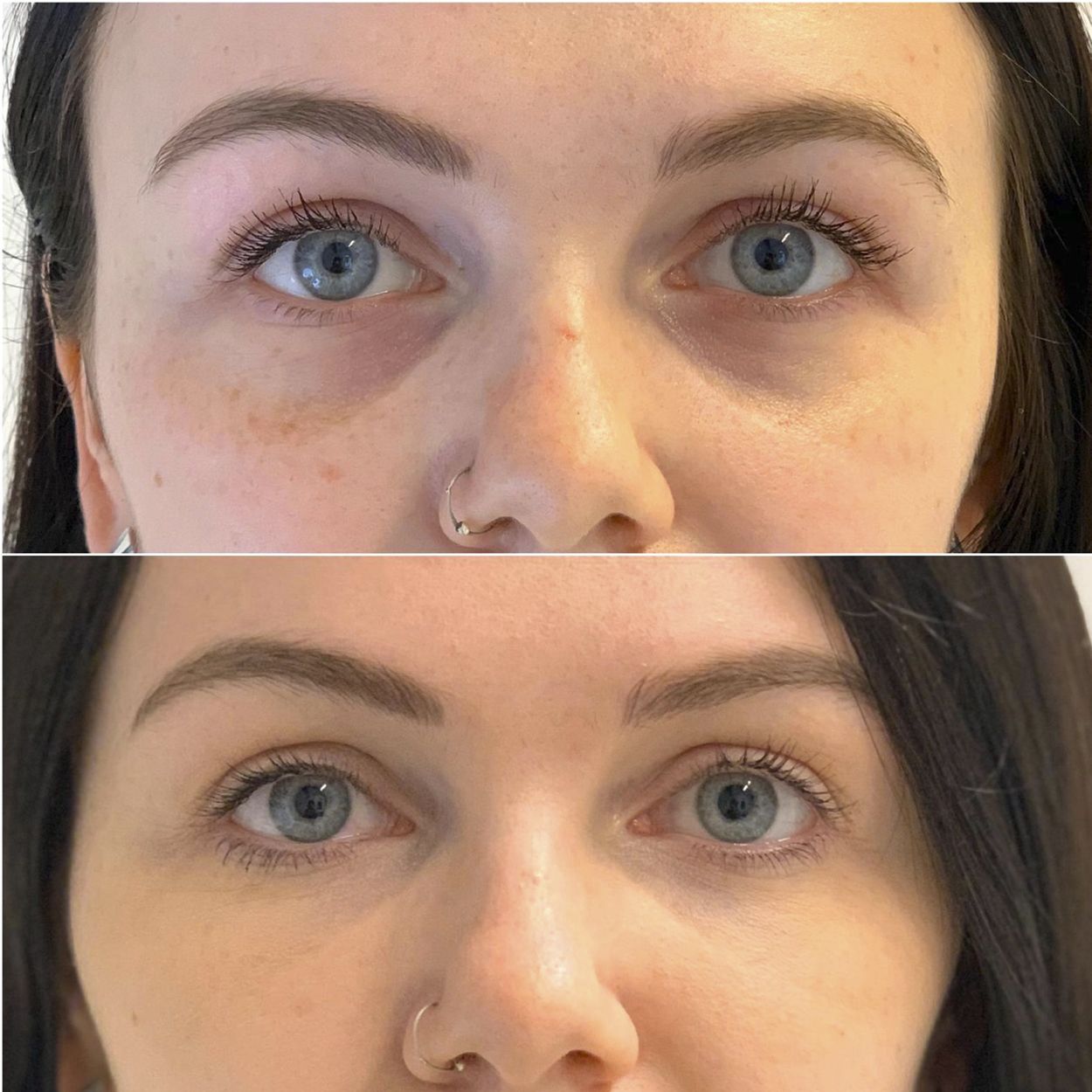 Blefaroplastia faceliftului inferior