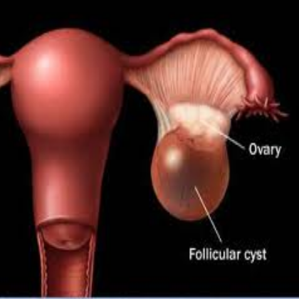 5 Ways To Treat Cyst On Ovary Symptoms Ovarian Cyst Follicular Cyst Ovarian Cyst Causes