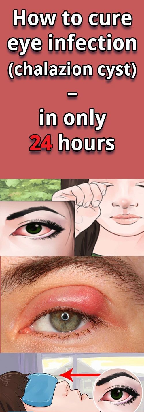 Put A Drops Of Colloidal Silver In Your Eye My Daughter Had Put A Drops Of Colloidal Silver In Your Eye My Daughter Had Spider