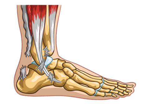 Achilles Tendon Rupture Achilles Tendon Ruptures Achilles Tendonitis Achilles Tendonitis Surgery