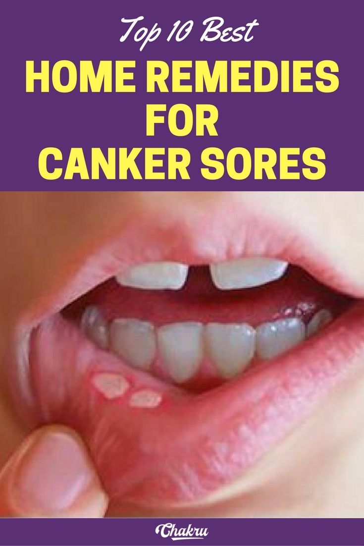 best home treatment for canker sores