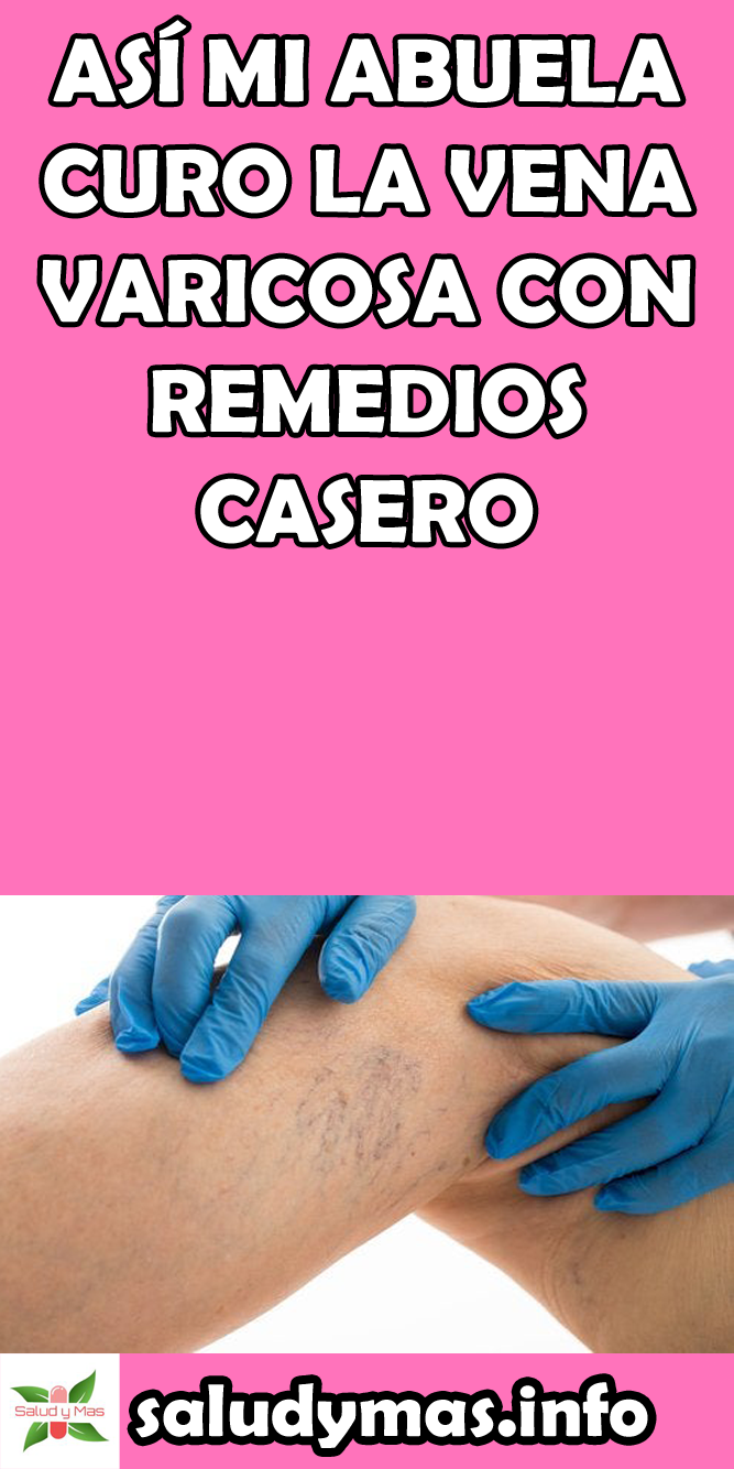 reeta de la varicoza