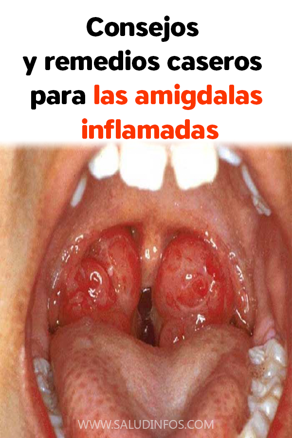 Brokenheartedness De Tragadero Imagenes De Amigdalas Inflamadas