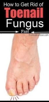How to get rid of toenail fungus quickly at home. The following habits could be … How to get rid of toenail fungus quickly at home. The following habits could be …