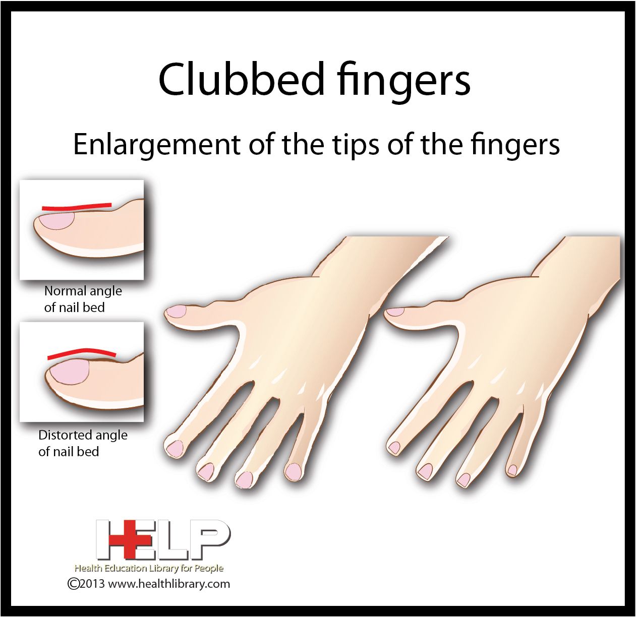 Clubbed Fingers Clubbed Fingers Contouring And Highlighting Health Clubbed Fingers Clubbed Fingers Contouring And Highlighting Health