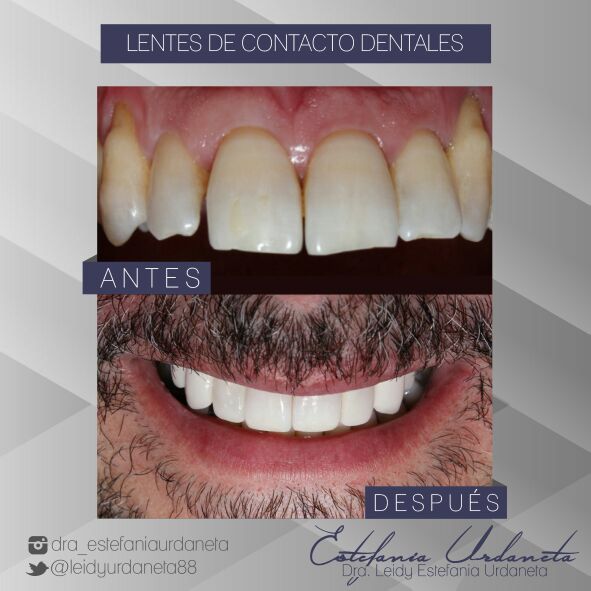 Odontologia Minimamente Invasiva Estetic Lentesdecontactodentales Estetica Odontologia Passion Pasion Pzo Beauty Lipstick