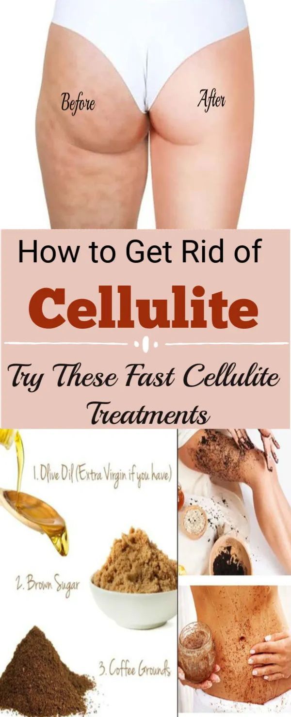 Get Rid of Cellulite Fast and Naturally Cellulite Wrap, Causes Of Cellulite, Cellulite Exercises, Cellulite Remedies, Cellulite Scrub, How To Reduce Cellulite, Bloating Remedies, Herbal Remedies, Home Remedies