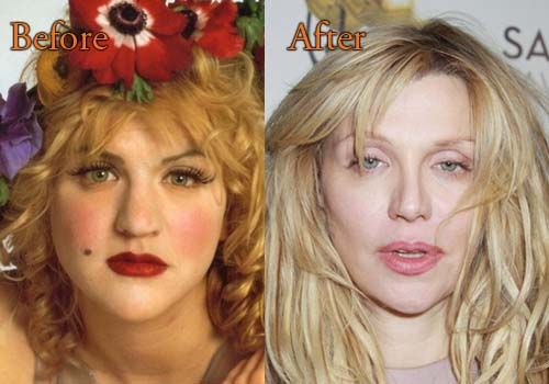 free courtney love plastic surgery