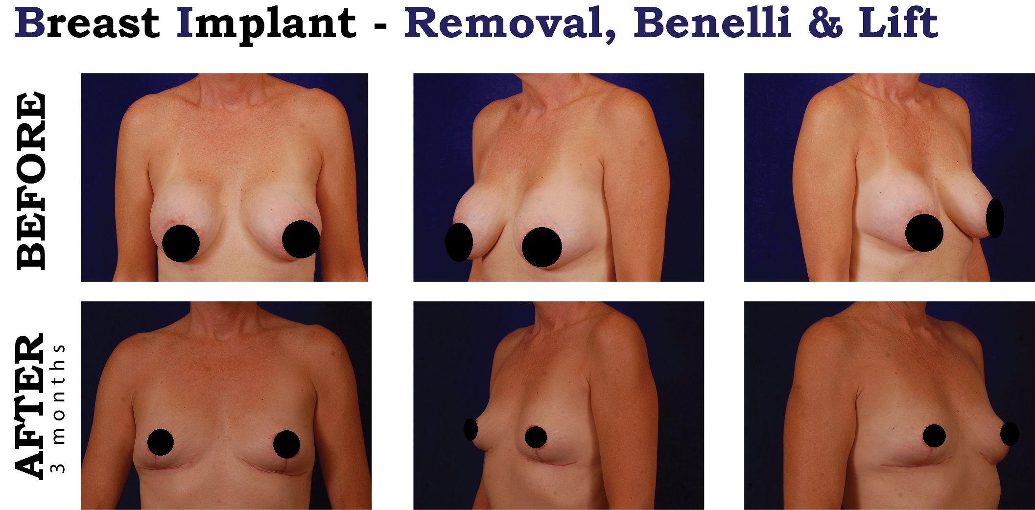 breast augmentation doctors lansing michigan Breast augmentation doctors lansing michigan
