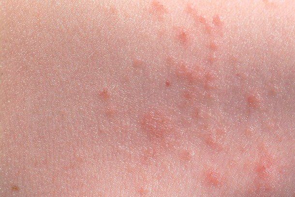 Skin Rashes On Toddlers