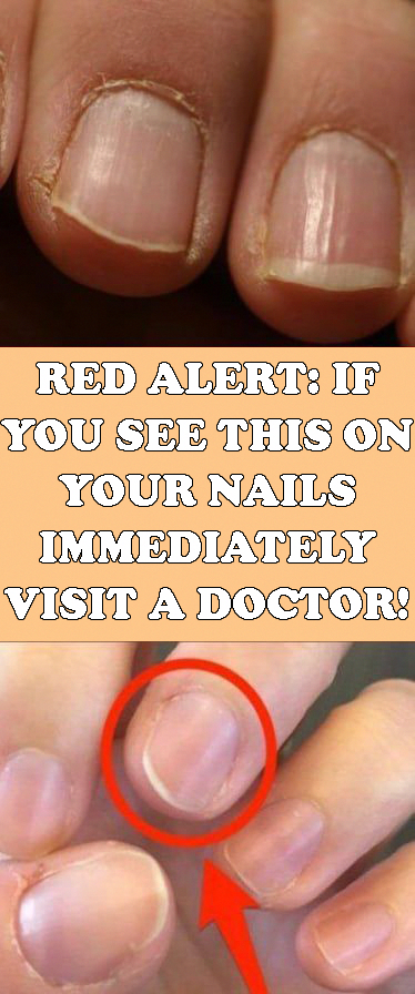If You See This On Your Nails Immediately Visit A Doctor! - #health #healthy #fitness #beauty #women...