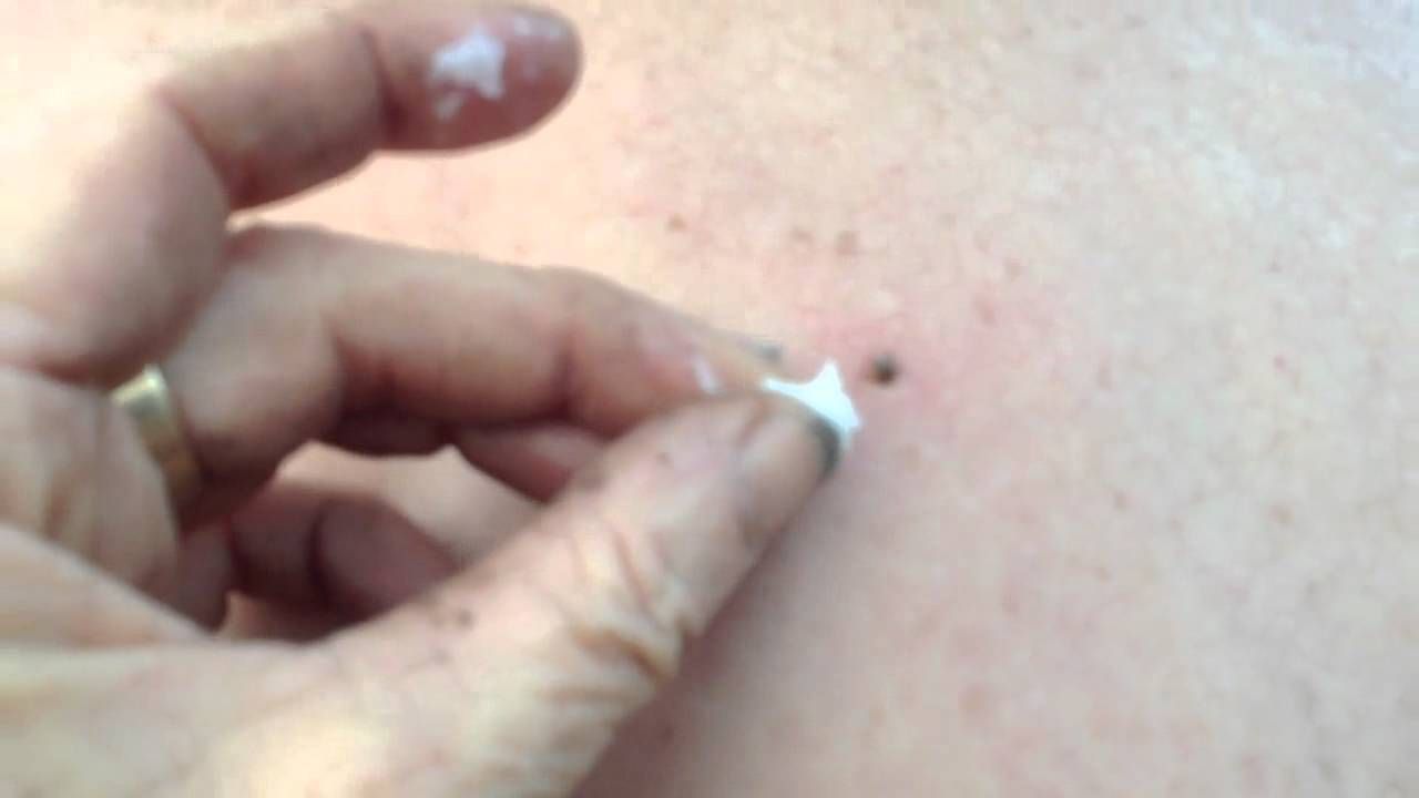 Can You Use Vaseline On Tattoos Tattoo Removal Clinic Does Vaseline Remove Tattoo Ink Tattoo Removal Before And After Healing Tatto Eyebrow Tattoo Removal Tattoo Removal Tattoo Removal Cost