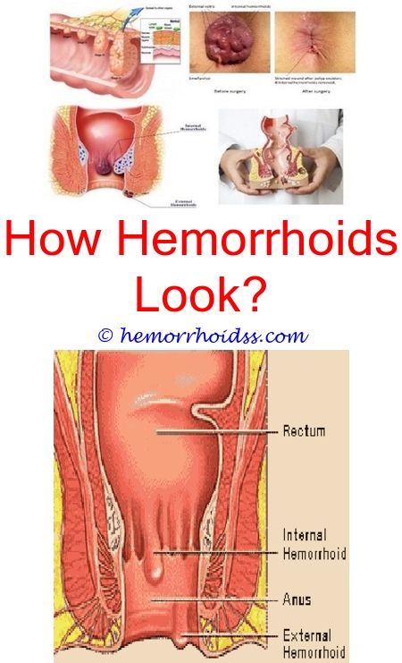 Can u get hemorrhoids from anal sex Can u get hemorrhoids from anal sex