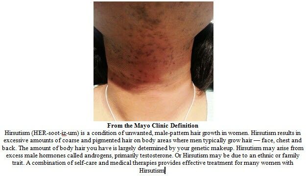 Polycystic Ovarian Syndrome Hirsutism Natural Treatment Polycystic Ovarian Syndrome Hirsutism Natural Treatment