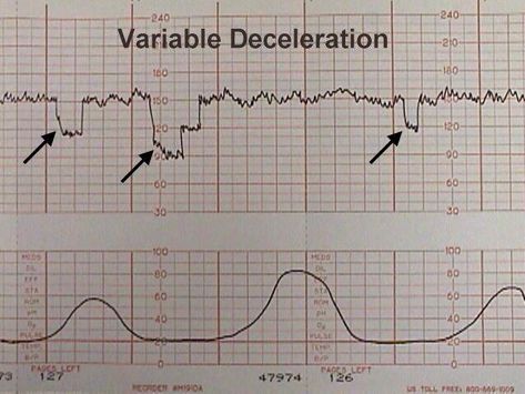 Electronic Fetal Monitoring Video - The Brookside Associates
