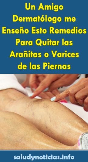 plantas medicinales para eliminar las varices