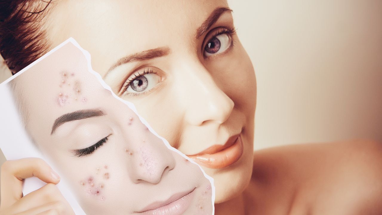 طريقة إزالة حب الشباب Korean Beauty Tips Acne Prescription Prescription Acne Medication