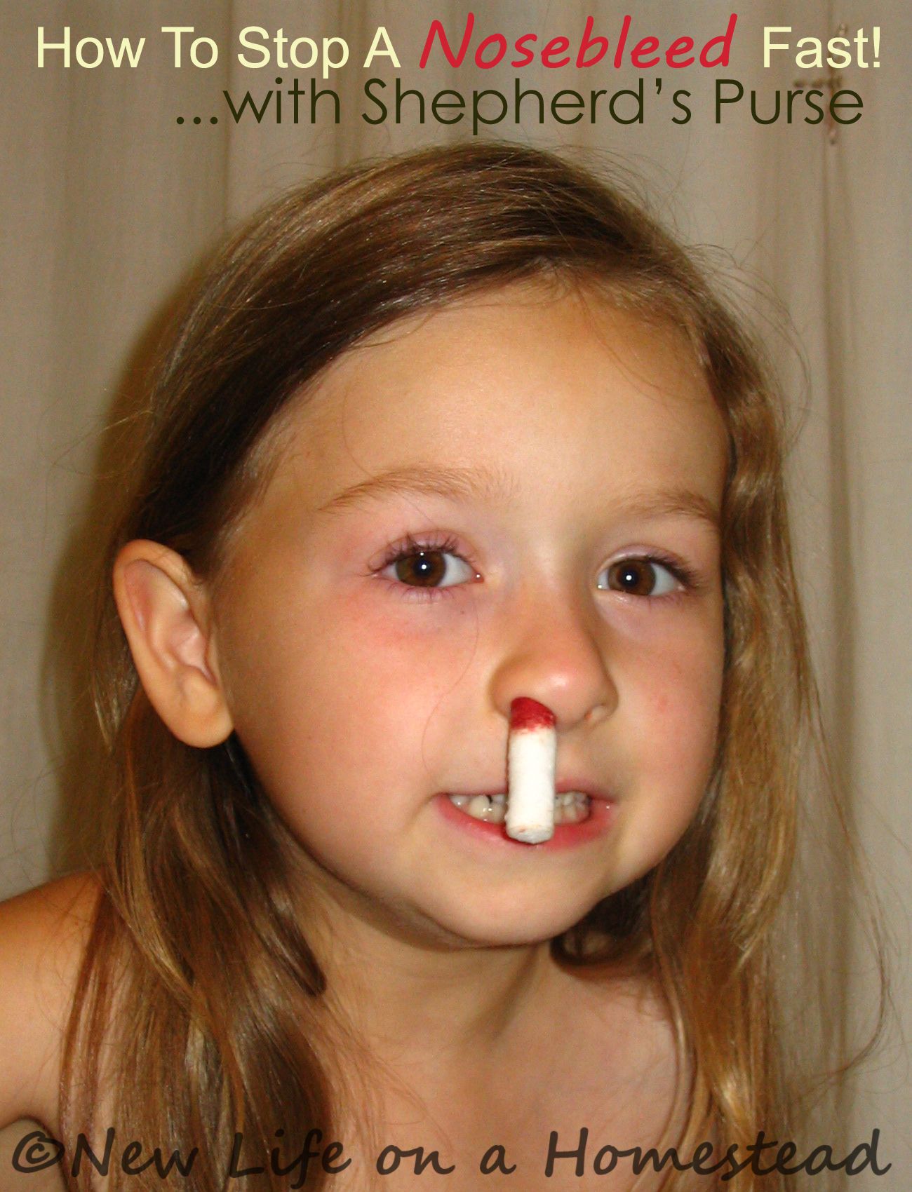 Effective ways to quickly stop nosebleeds Effective ways to quickly stop nosebleeds