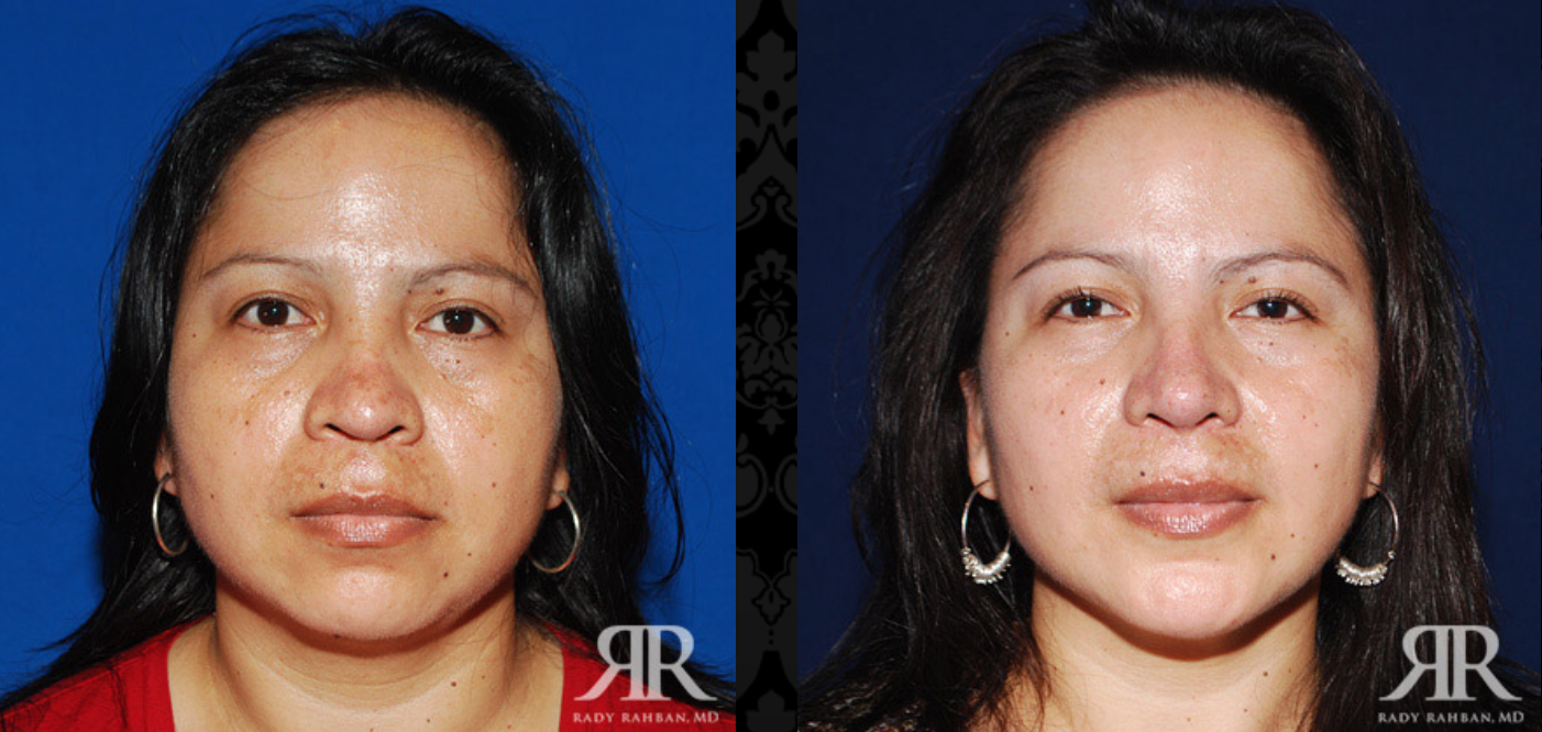 Pin by Rady Rahban, MD on Chin Augmentation Rhinoplasty, Plastic