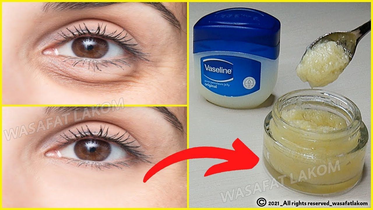 In 3 days Remove Under Eye Bags Completely | Remove Dark Circle, Wrinkles, Puffy EyesDark circles under the lower eyelid are common in both men and women. Da... Eye Wrinkles Makeup, Eye Wrinkles Remedies, Eye Bag Remedies, Puffy Eyes Remedy, Wrinkle Remedies, Under Eye Wrinkles, Skin Care Wrinkles, Face Wrinkles, Bag Under Eyes Remedy