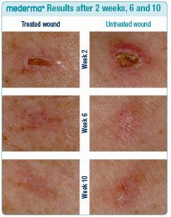 mederma before and after