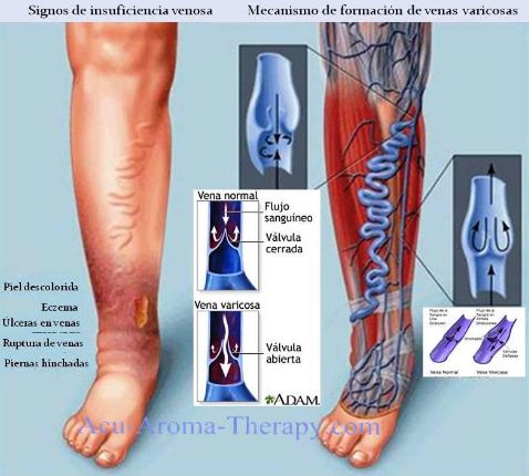 Varicoză venă foot-stage-tratament tratament ceaiuri rinichi