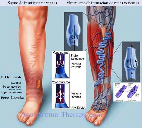 varicoza i medicina alternativa