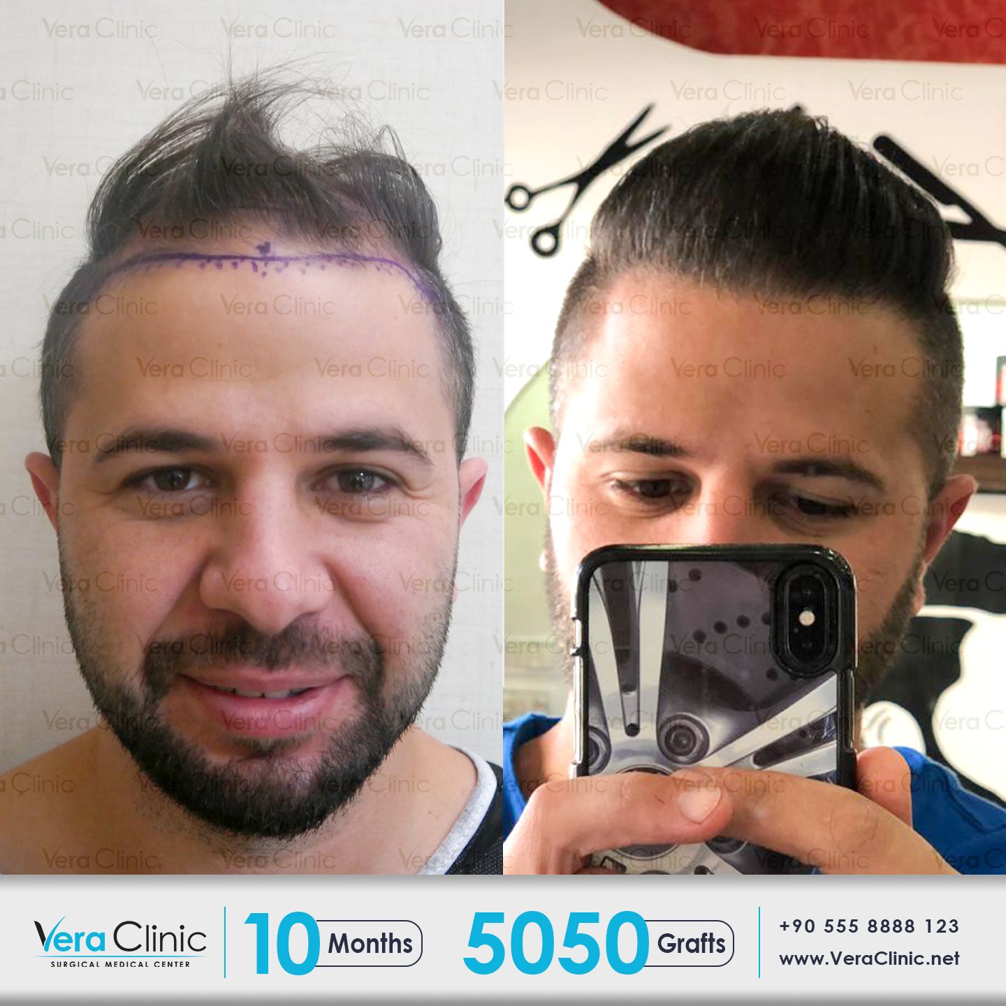 Vera Clinic Hair Transplant in Turkey Hair transplant, Hair Vera Clinic Hair Transplant in Turkey Hair transplant, Hair