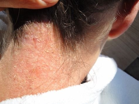 skin overgrowth skin overgrowth