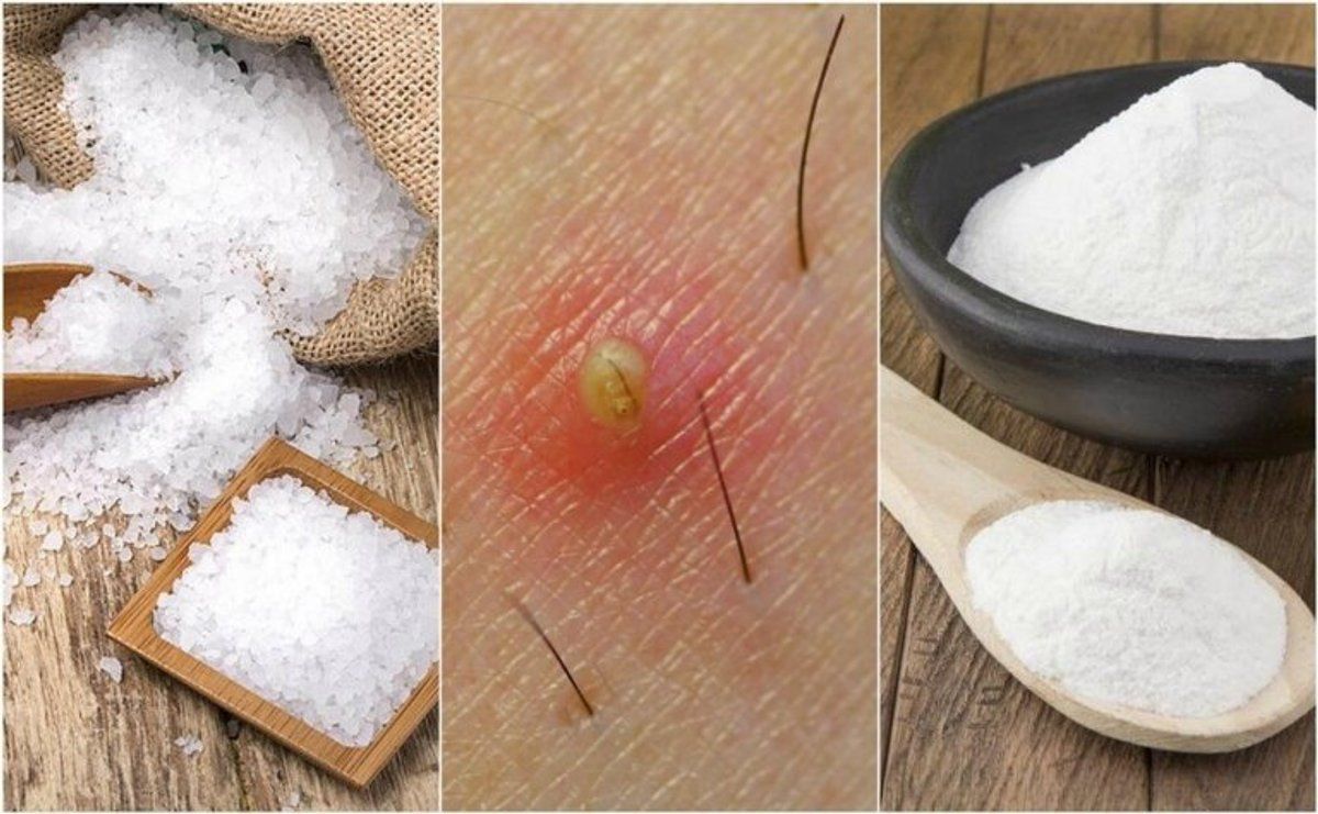 埋没毛を解決する5つの自然療法 Ingrownhairneck Ingrown Hair Treat Ingrown Hair Infected Ingrown Hair 埋没毛を解決する5つの自然療法 Ingrownhairneck Ingrown Hair Treat Ingrown Hair Infected Ingrown Hair