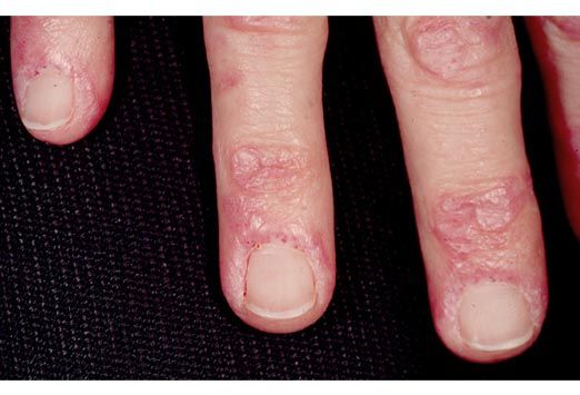 dermatomyositis gottrons papules
