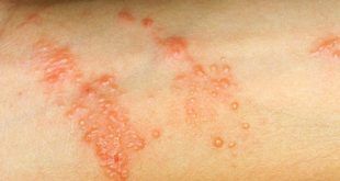 How To Get Rid Of Poison Ivy Rash Remes How To Get Rid Of Poison Ivy Rash Remes
