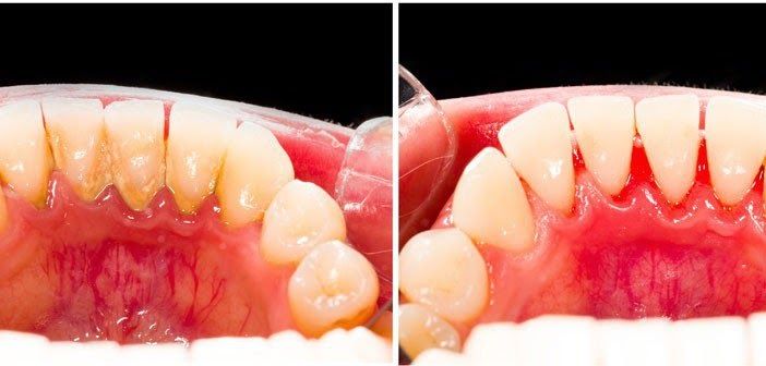 How To Remove Plaque Naturally At Home In Natural Conditions How To Remove Plaque Naturally At Home In Natural Conditions