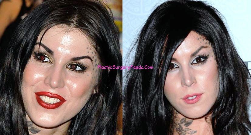 Kat Von D Plastic Surgery Before and After Photo Lip job, Nose job