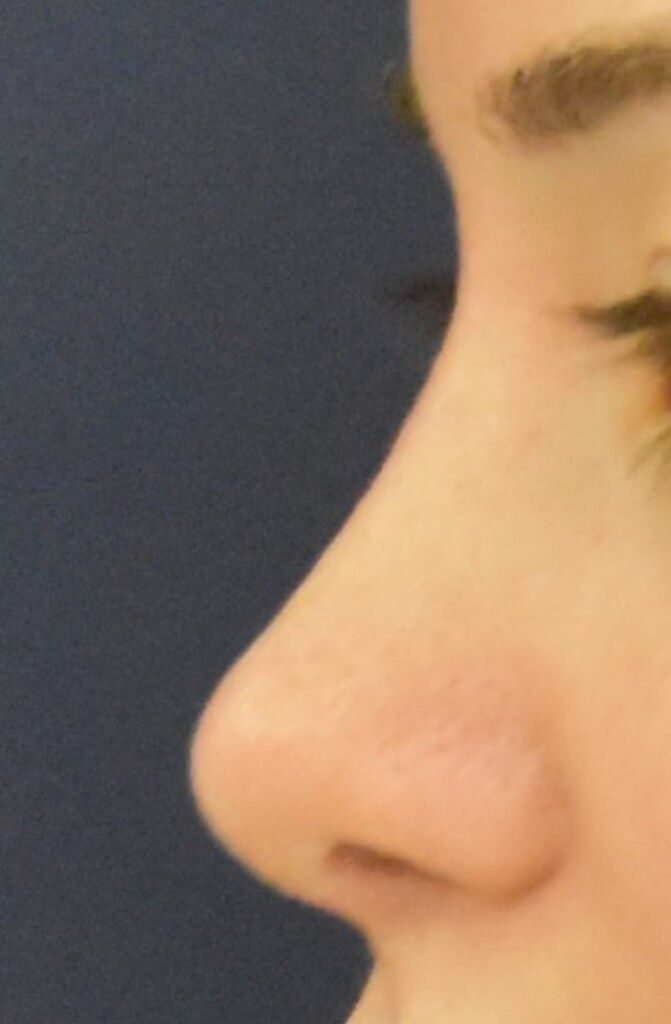 Rhinoplasty Before and After Gallery NYC New York Long Island