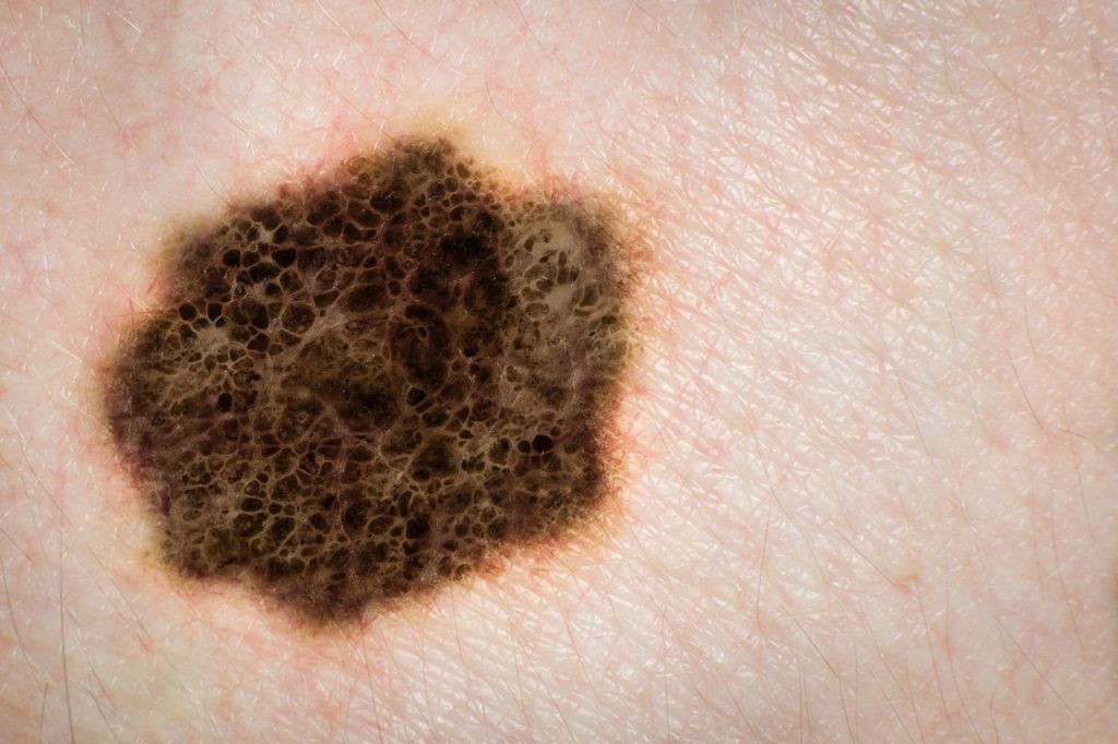 Pin on Melanoma Info